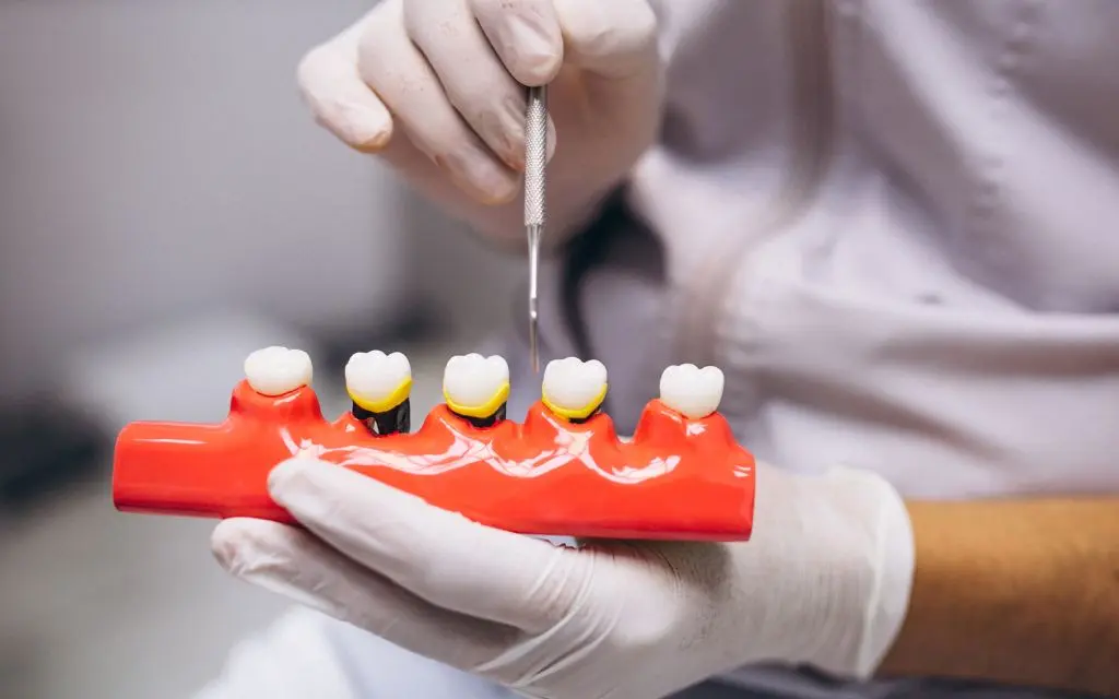 Dental Crowns